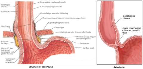 Achalasia4