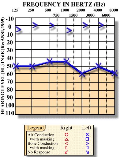 Conductive hearing loss