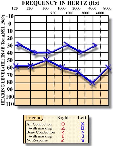 Mixed hearing loss