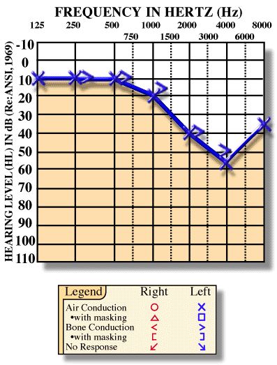 Sensorineural hearing loss