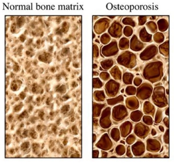 Osteoporosis1