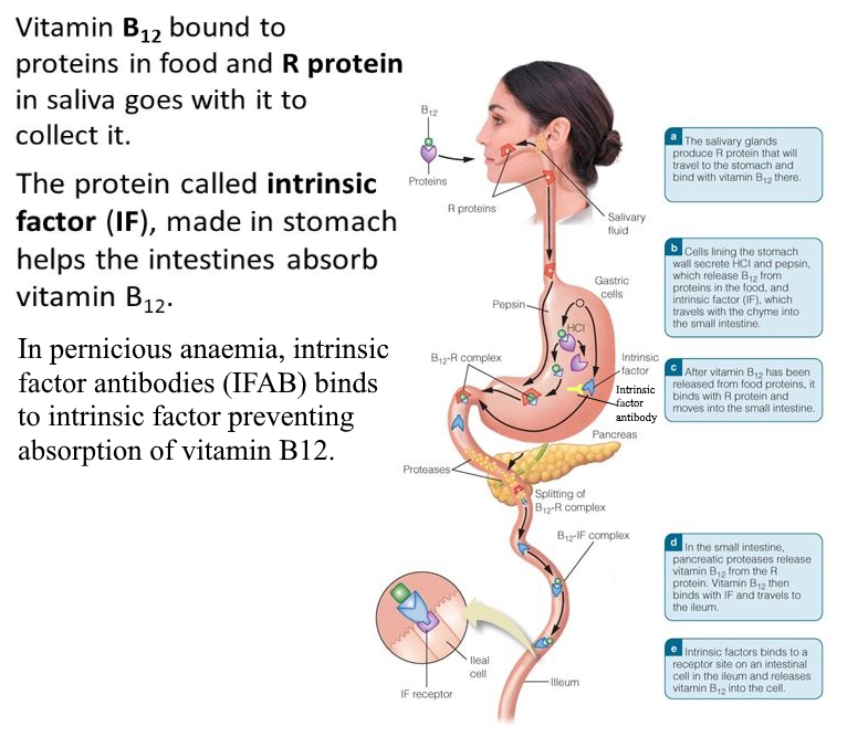 pernicious anaemia