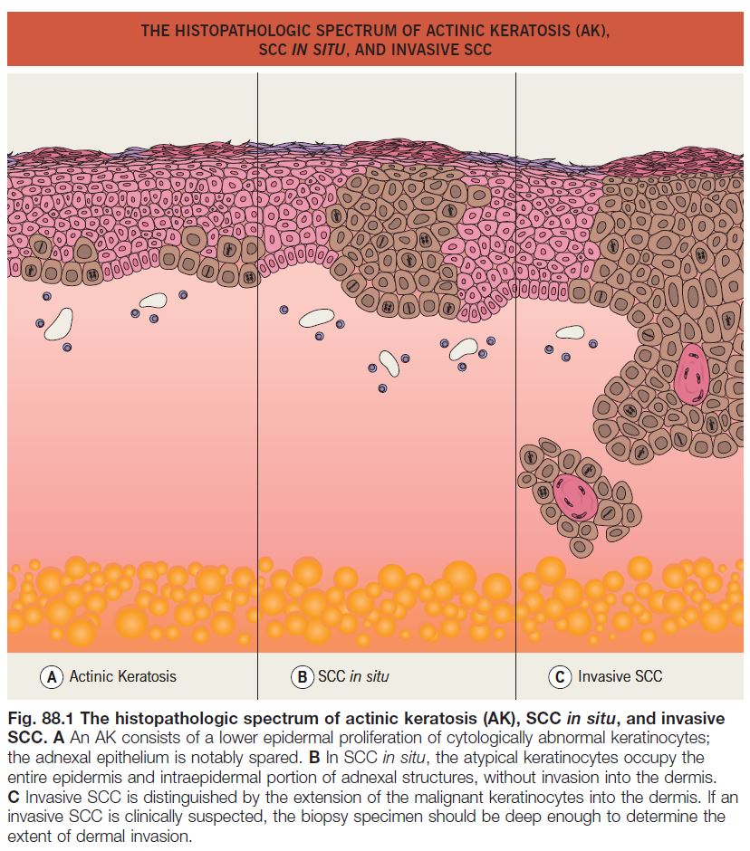 Actinic Keratosis Basal Cell Carcinoma And Squamous Cell Carcinoma Chapter 88 4700