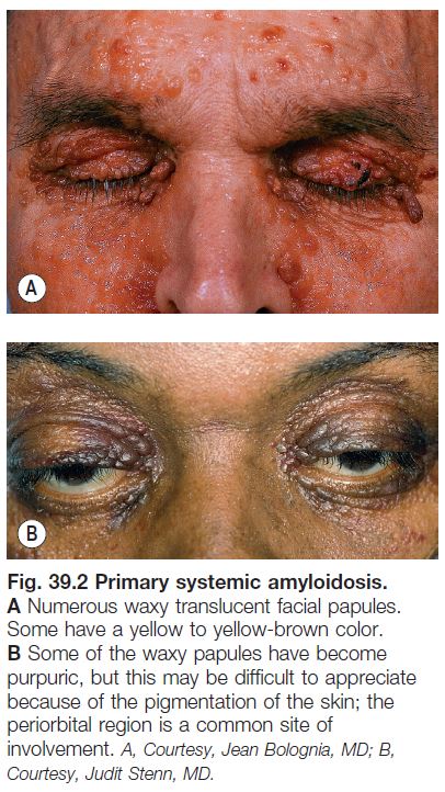 nodular amyloidosis