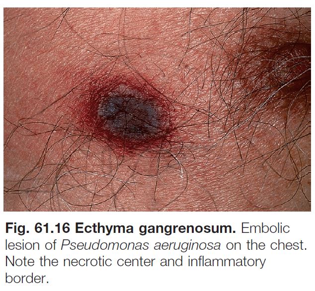 Inflammatory papulonodules and crusts on the inner thigh before