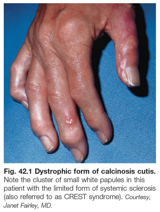 calcinosis