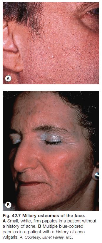 calcinosis cutis face