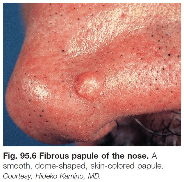 fibrous papule