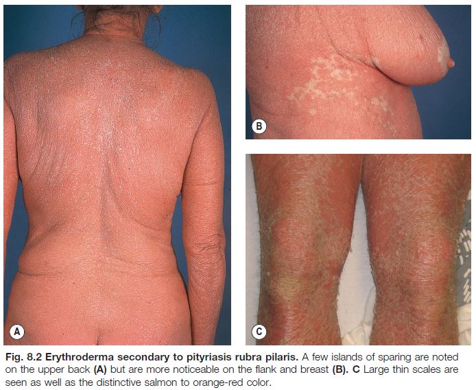 Erythroderma deals