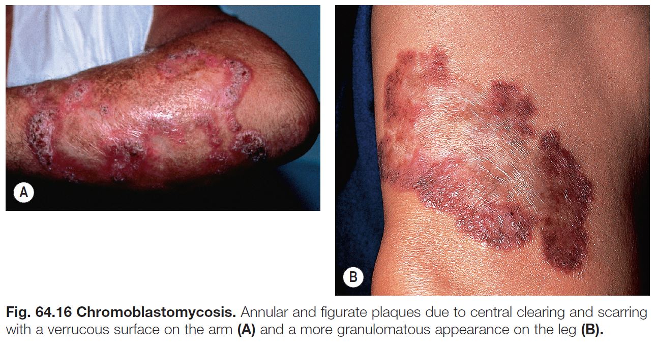 Fungal Diseases Chapter 64