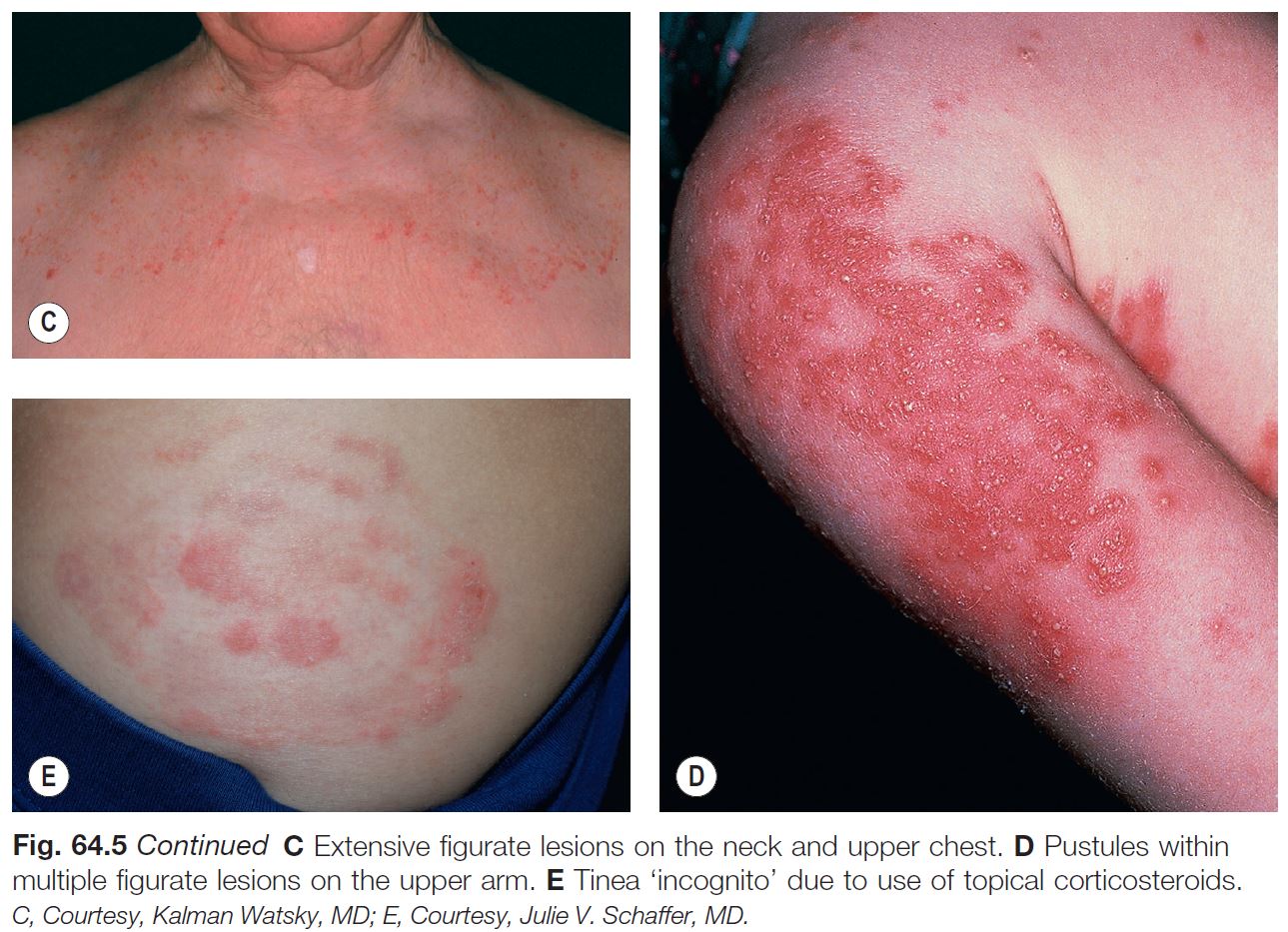 Fungal Diseases Chapter 64