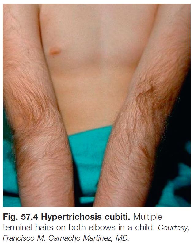 hypertrichosis female