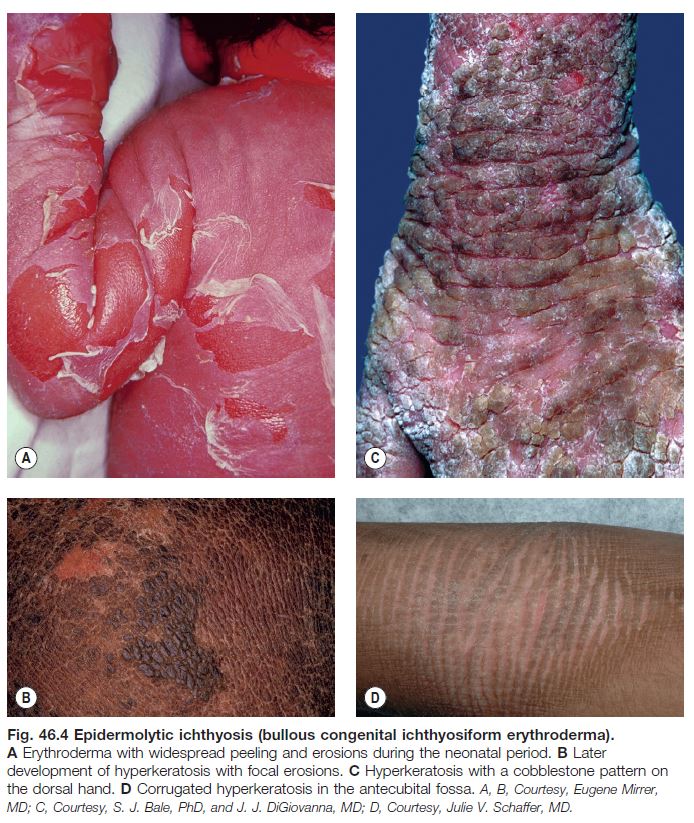 severe ichthyosis vulgaris