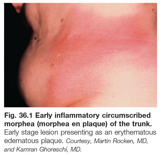Generalized Morphea