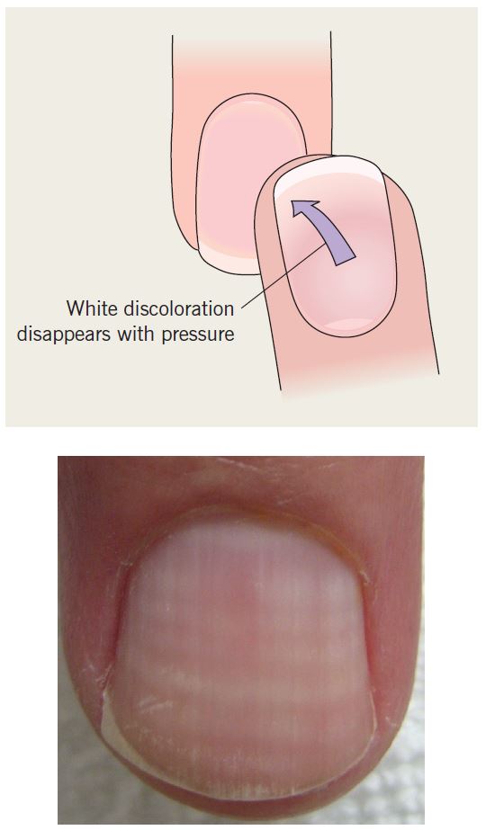 Apparent leukonychia