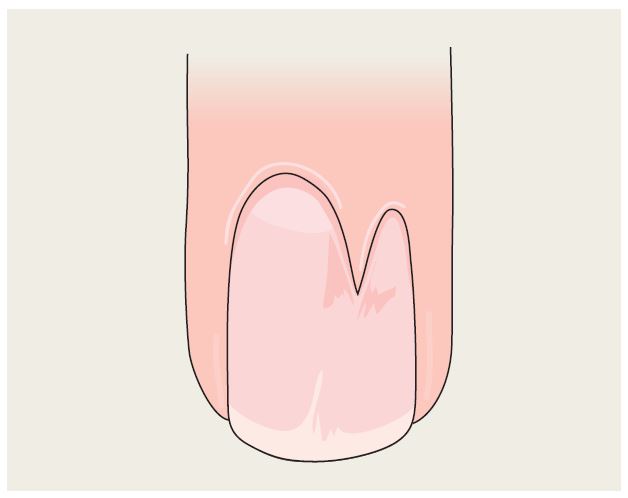 Dorsal pterygium