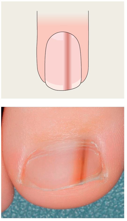 Longitudinal melanonychia