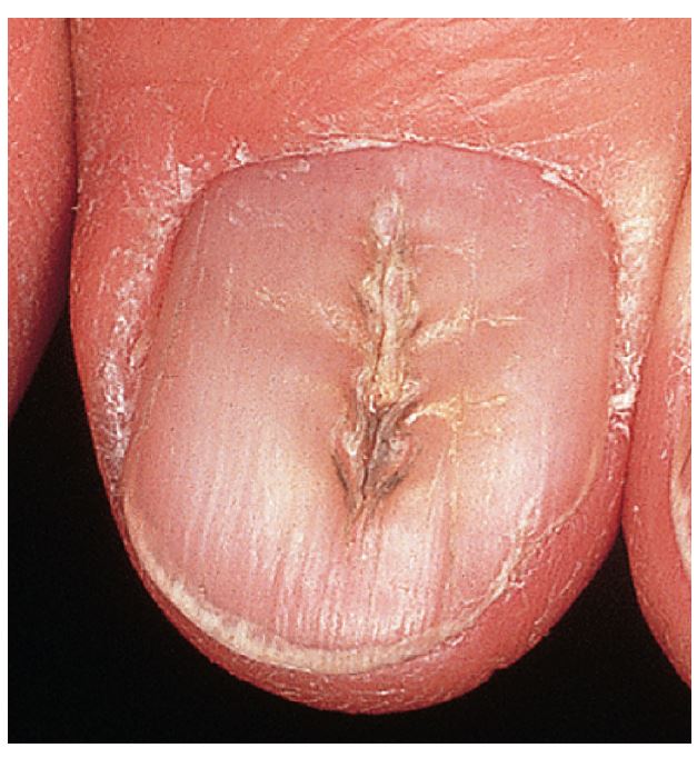 Median nail dystrophy