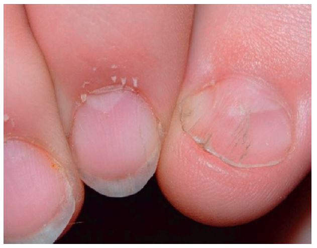 Nail patella syndrome