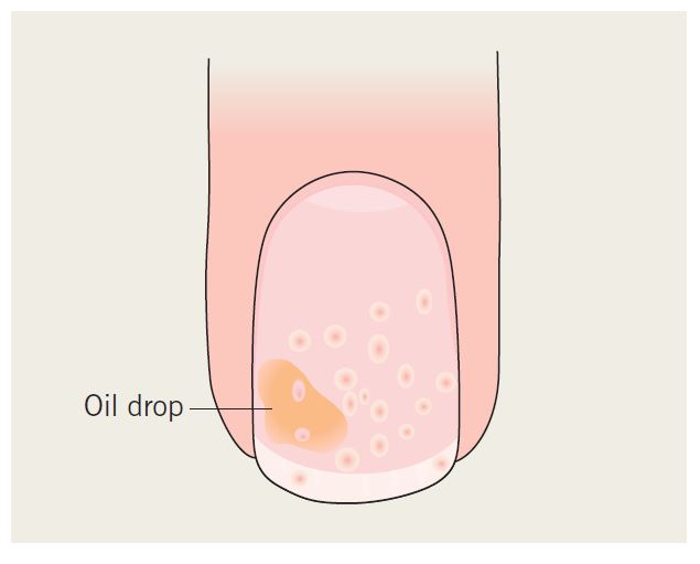 Pitting psoriasis 1