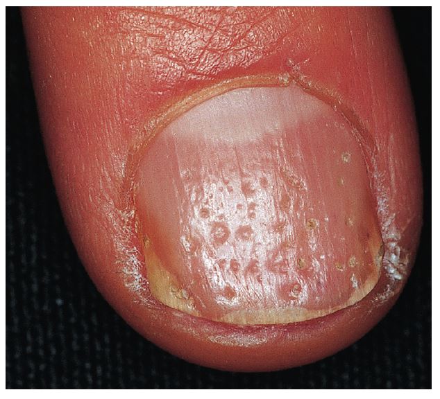 Pitting psoriasis 2