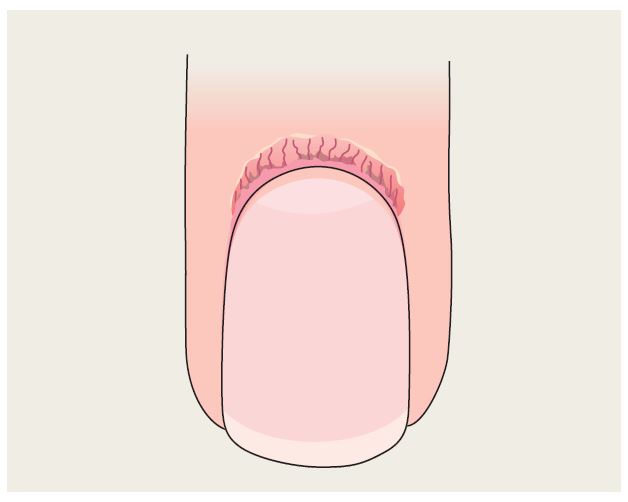 Proximal nail fold telangiectasias