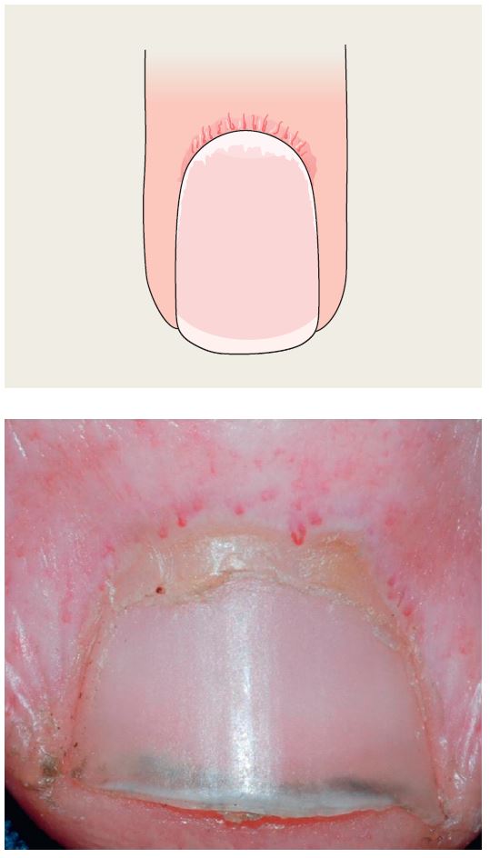 Proximal nail fold telangiectasis capillary dropout