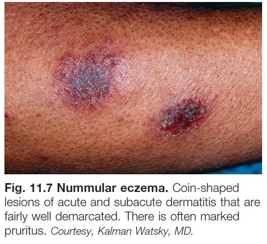 Other Eczematous Eruptions Chapter 11