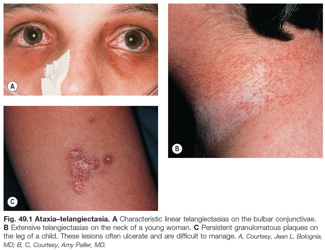 ataxia telangiectasia skin