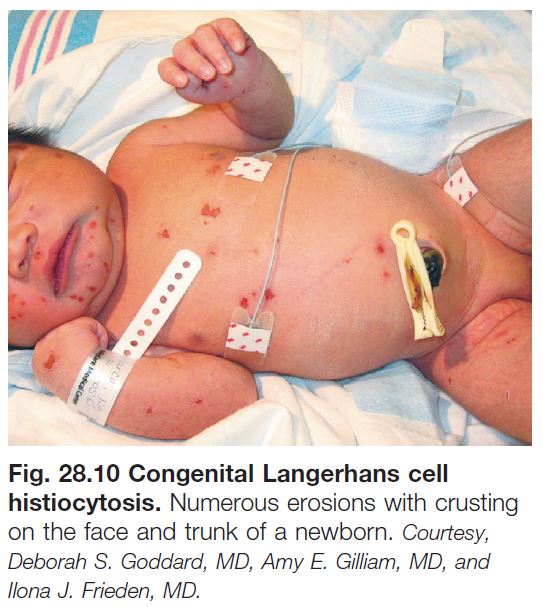 Langerhans Cell Histiocytosis Diaper Rash