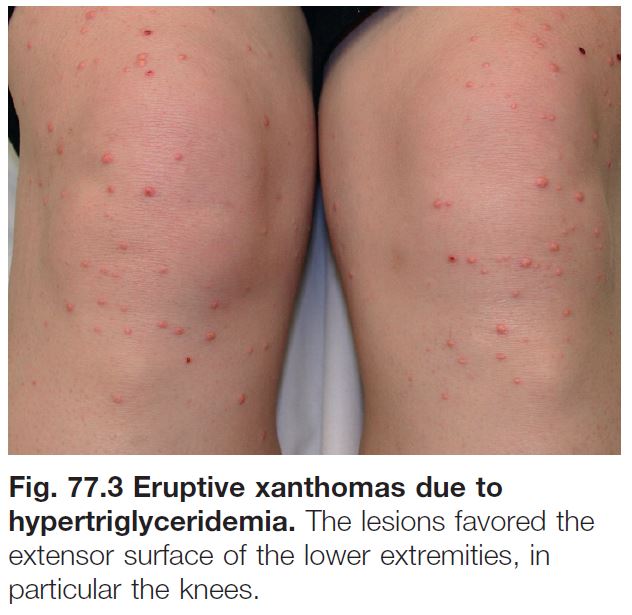 eruptive xanthomatosis