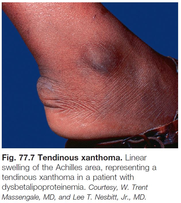 Tendinous Xanthomas