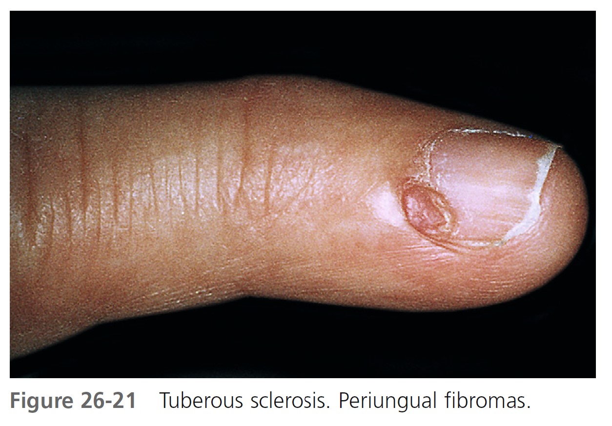 SciELO - Brasil - Tuberous sclerosis complex Tuberous sclerosis complex