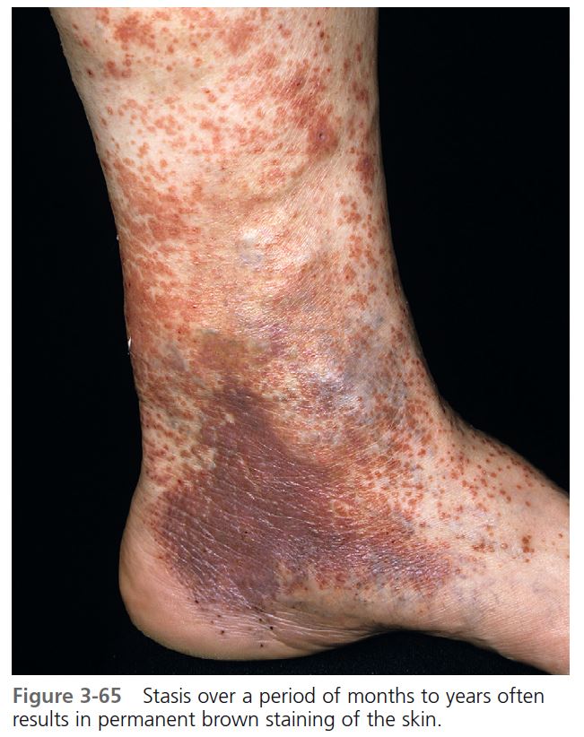 Multiple, 1‐2 cm, ulcerations and hyperpigmented, depressed scars on