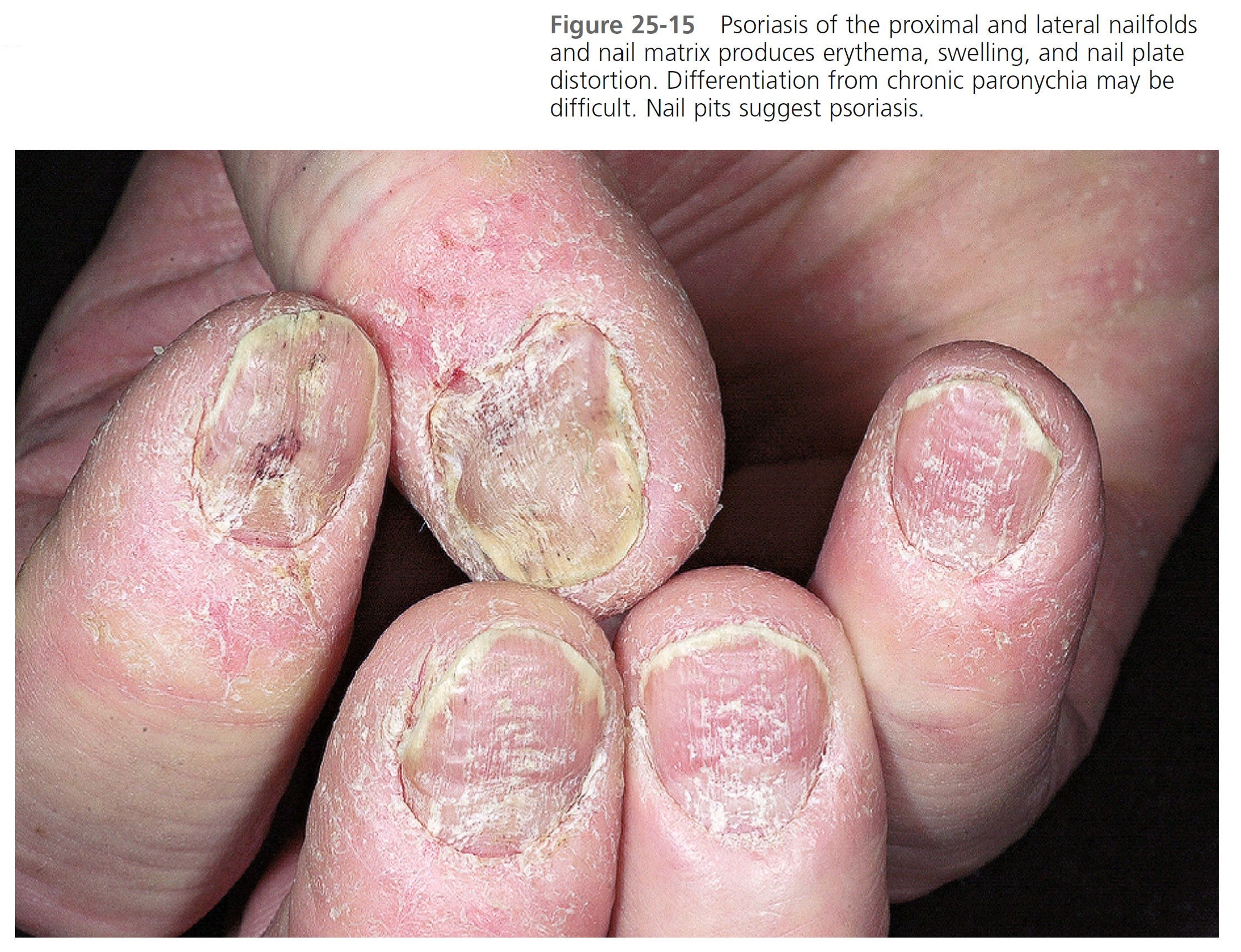 Nails in systemic disease | RCP Journals