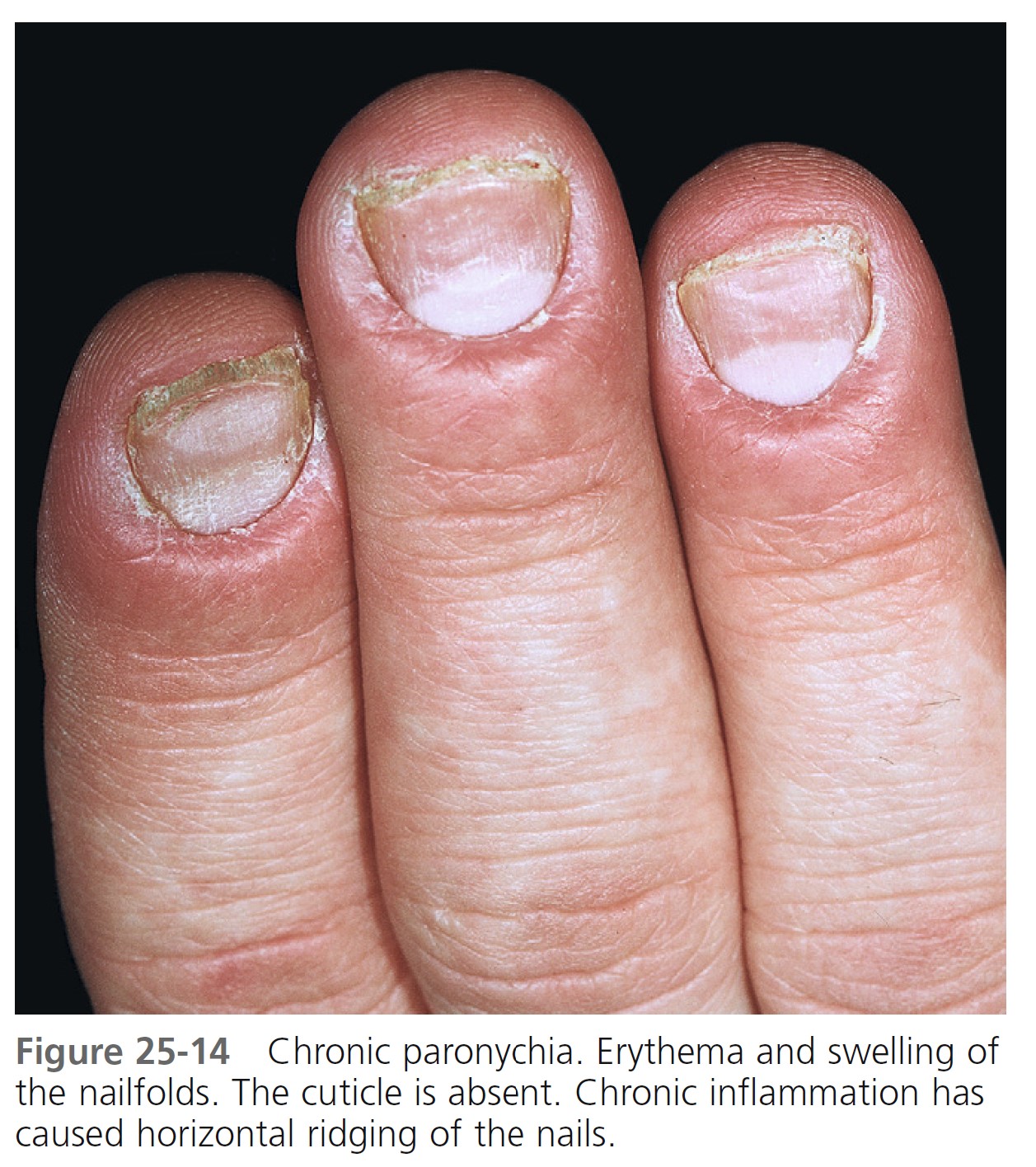 The nails Infections