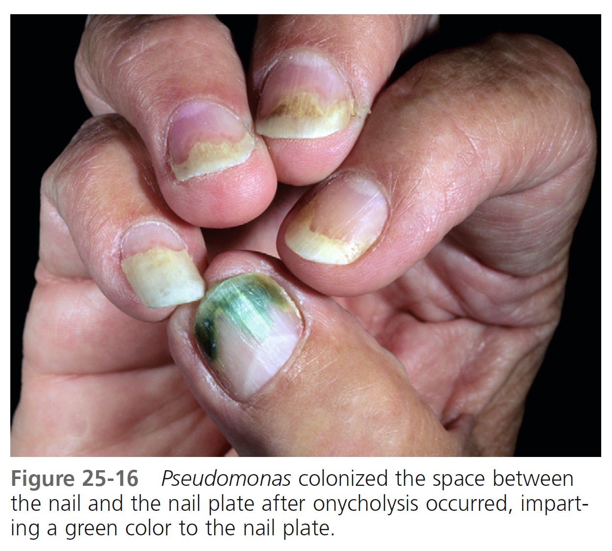 Figure 1 from Green Nail Syndrome (Pseudomonas aeruginosa Nail Infection):  Two Cases Successfully Treated with Topical Nadifloxacin, an Acne  Medication | Semantic Scholar