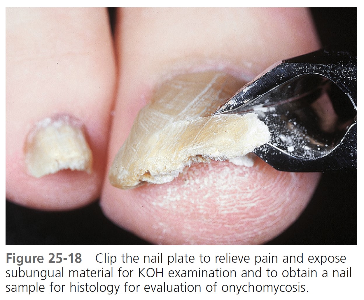 SciELO - Brasil - Nail clipping in onychomycosis and comparison with normal  nails and ungual psoriasis Nail clipping in onychomycosis and comparison  with normal nails and ungual psoriasis