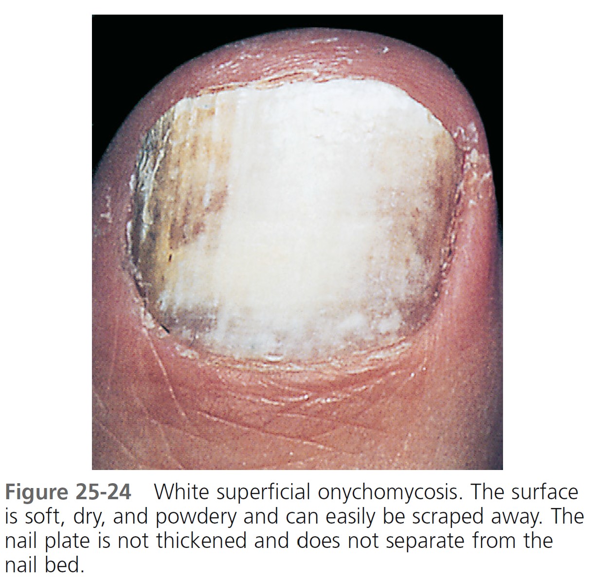 Cureus | The Coexistence of Trachyonychia and Mucocutaneous Lichen Planus:  A Case Report | Article