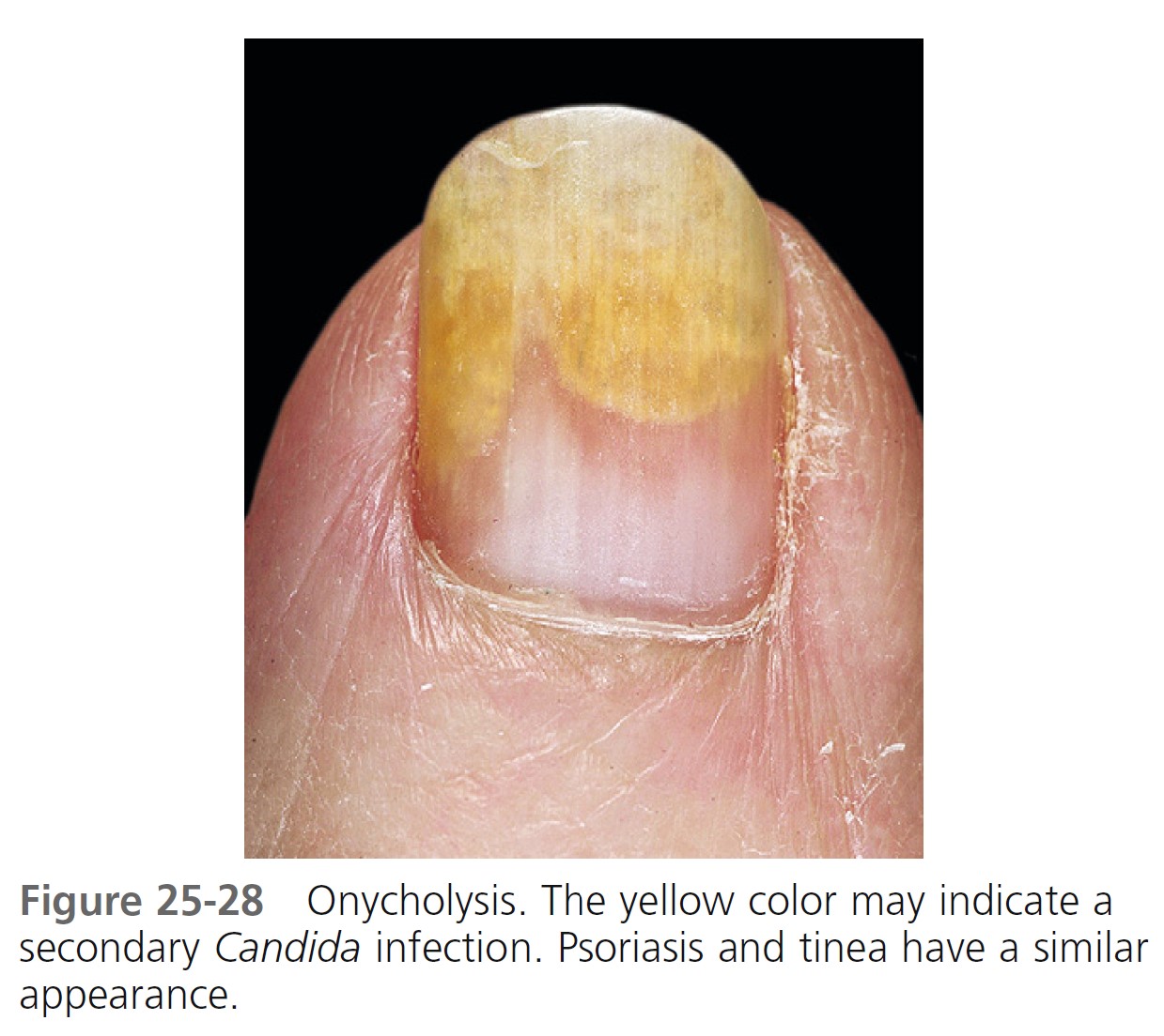 Prevention and Treatment of Toenail Fungus