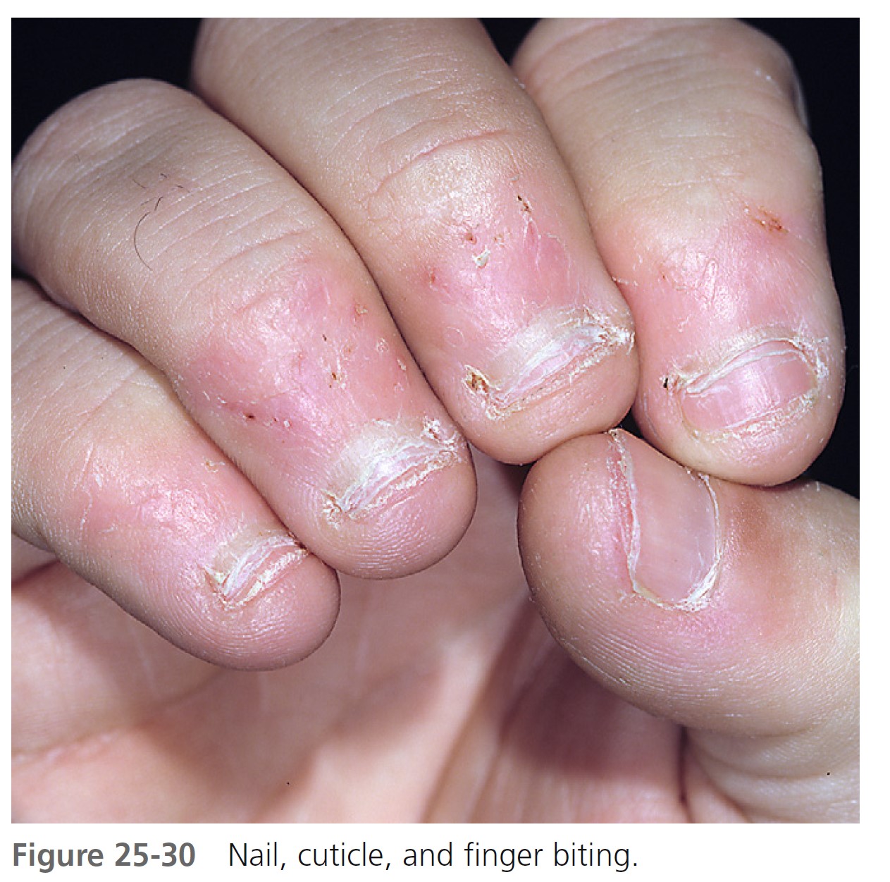 What causes black spots to appear on your nails after biting them? - Quora