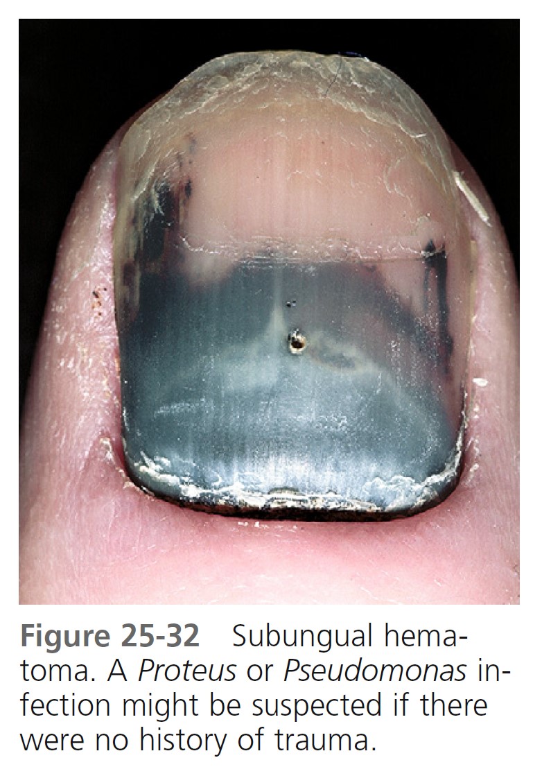 PDF] Non-Melanoma-Associated Dyschromia of the Proximal Nail Fold |  Semantic Scholar