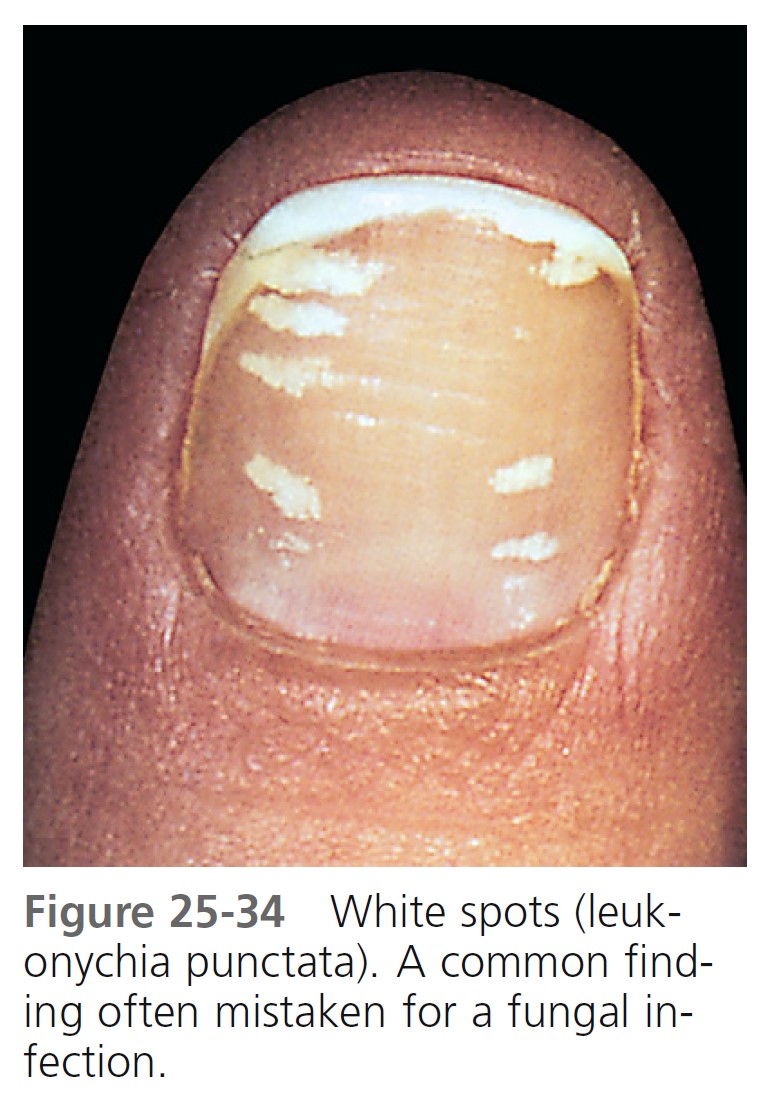 Effective treatment of severe nail psoriasis using topical calcipotriol  with betamethasone dipropionate gel - Indian Journal of Dermatology,  Venereology and Leprology