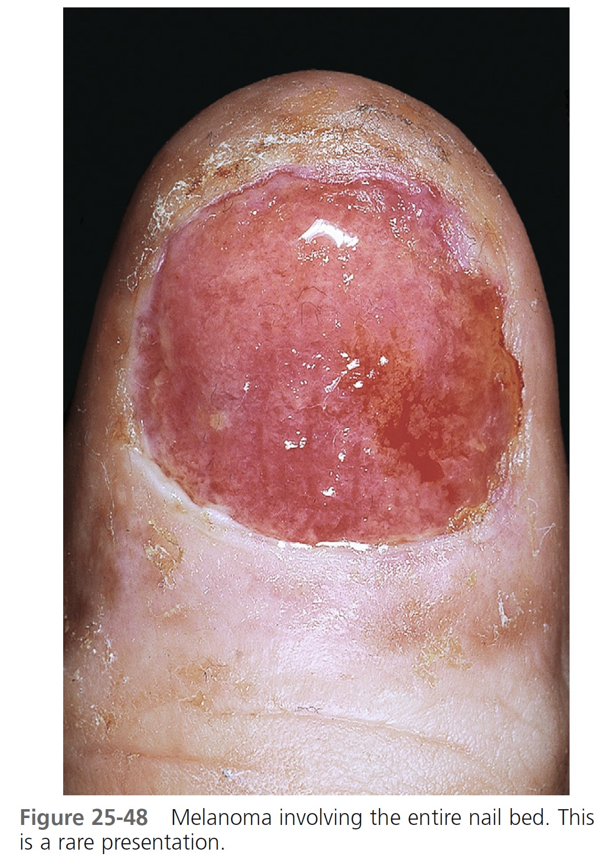 Subungual malignant melanoma | CMAJ