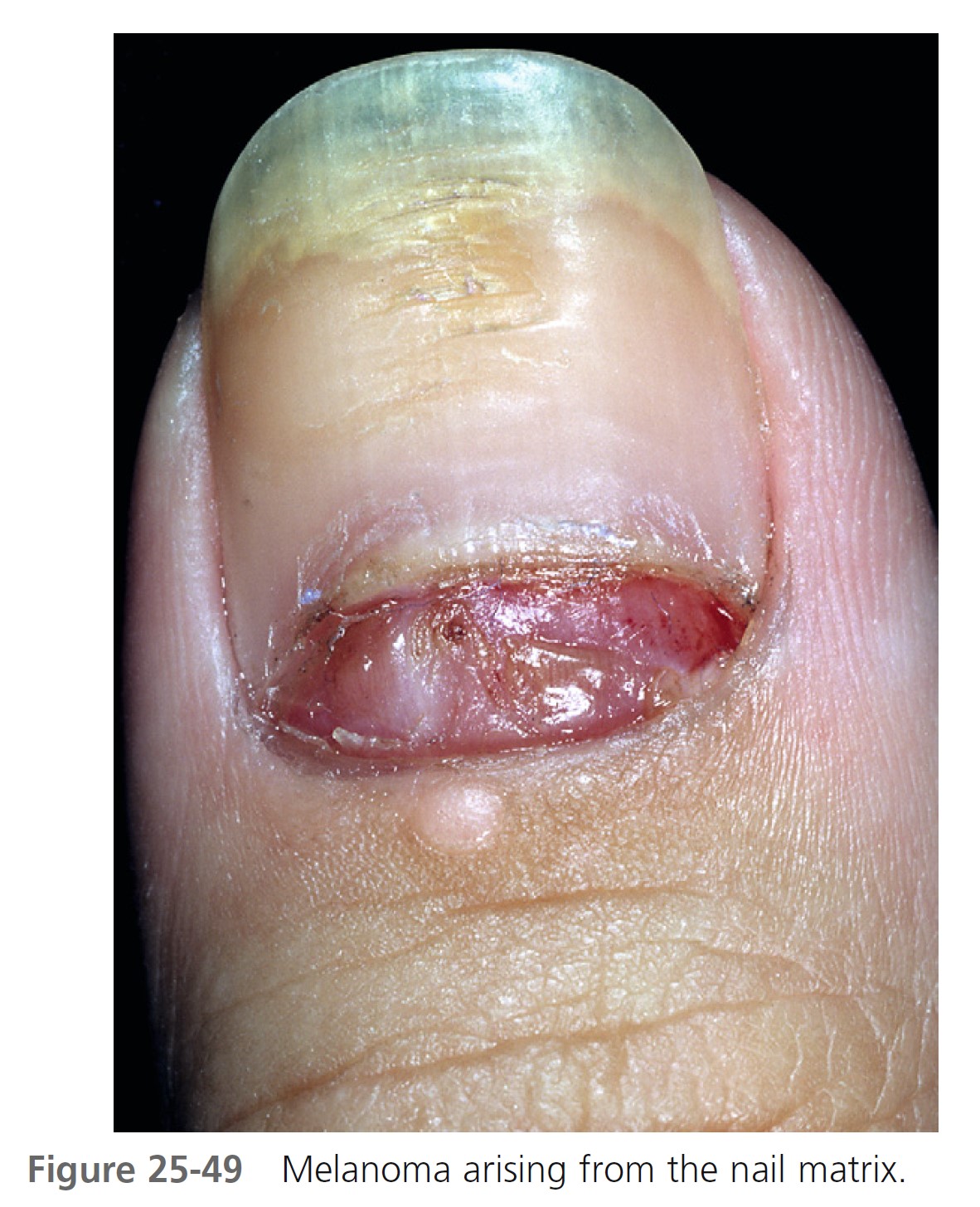 Nail is Systemic Disorders: Main Signs and Clues