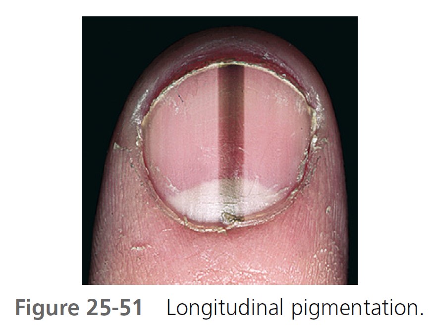 PDF) Diagnosis and management of nail pigmentations | Frederique Le Gal -  Academia.edu