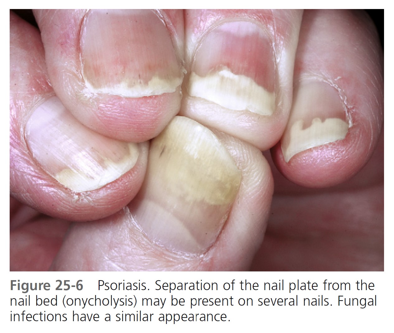 What's New in Nail Anatomy? Pterygium: What and Where is It? - Schoon  Scientific