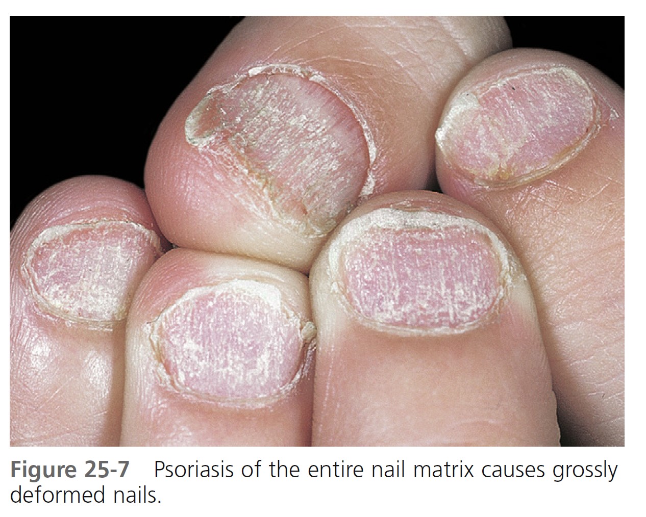 Psoriasiform Onychodystrophy Induced by Photobonded Acrylic Nails | JCAD |  The Journal of Clinical and Aesthetic Dermatology