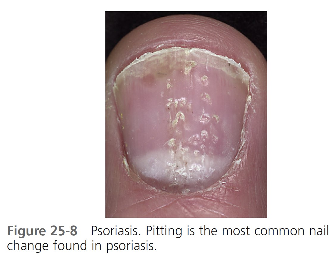 Paronychia Infection | PDF | Nail (Anatomy) | Infection