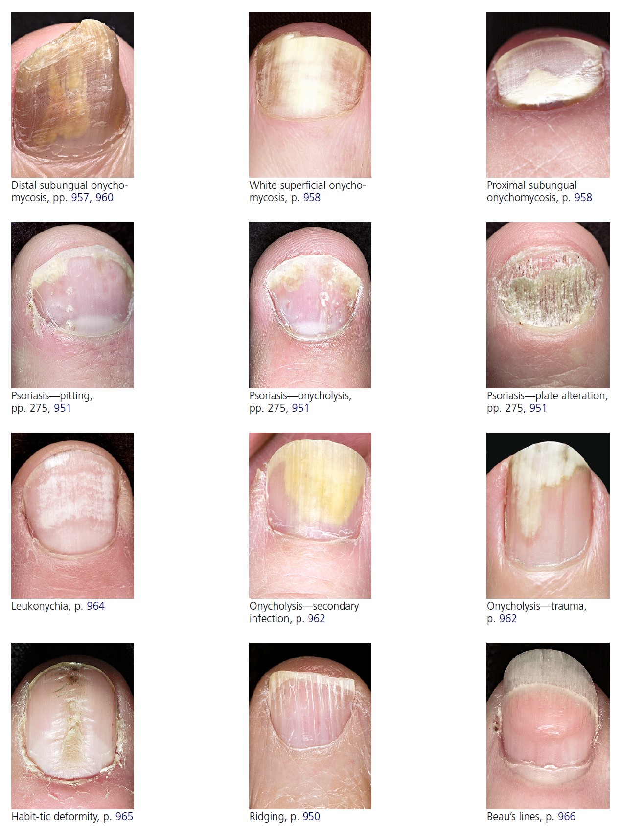 Eczema on Nails: What It Looks Like, How It's Treated